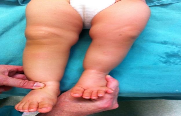 Dismetria dos Membros Inferiores