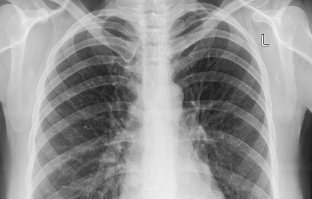 Fisioterapia no Derrame Pleural